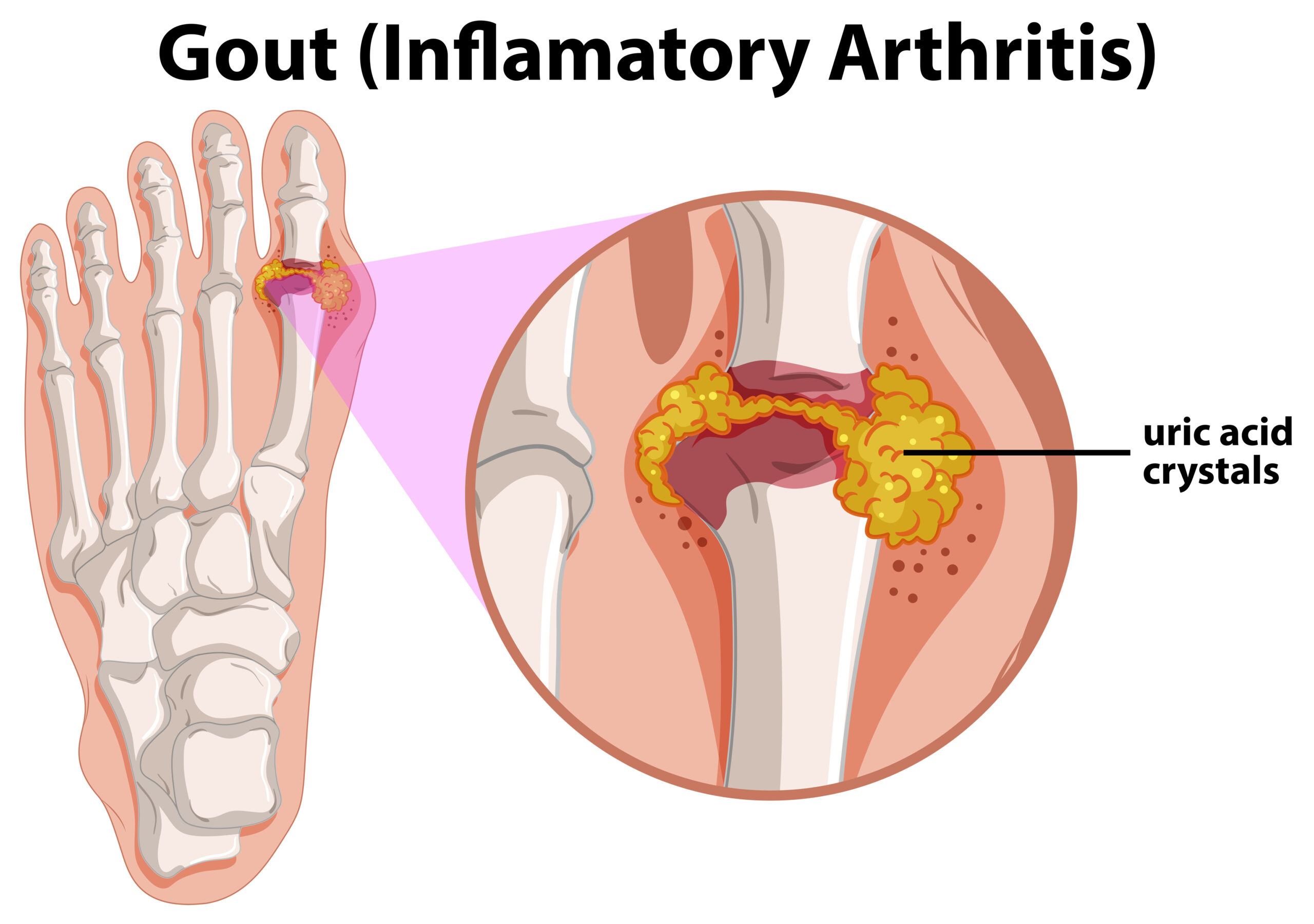 Diagram showing gout in human foot